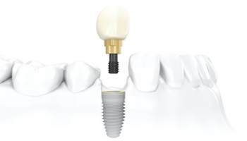 implant_t